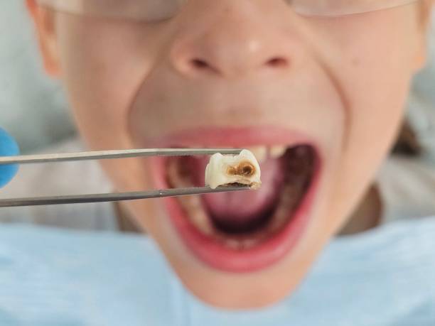 Best Emergency Wisdom Tooth Extraction in Fontana, CA